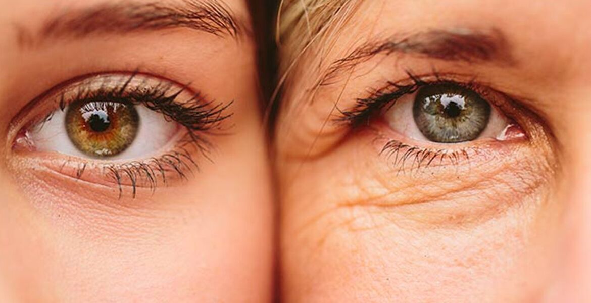Äußere Zeichen der Hautalterung um die Augen bei zwei Frauen unterschiedlichen Alters