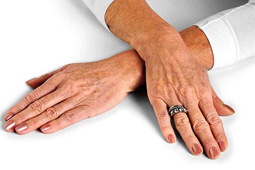 Haut der Hände mit altersbedingten Veränderungen, die den Einsatz von Verjüngungstechniken erfordern