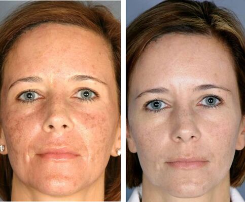 Vor und nach fraktionierter Gesichtsthermolyse. 