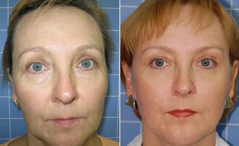 Vor und nach fraktionierter Laser-Gesichtsverjüngung