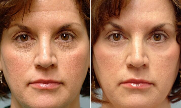 Gesicht vor und nach der fraktionierten Laserbehandlung